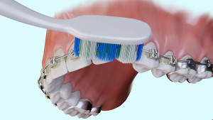 Nettoyage des brackets avec brossettes interdentaires