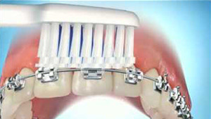 Brossage des dents avec des brackets