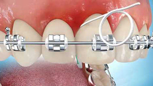 Nettoyage des brackets avec du fil dentaire