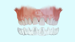 Traitement orthodontique esthétique par gouttières